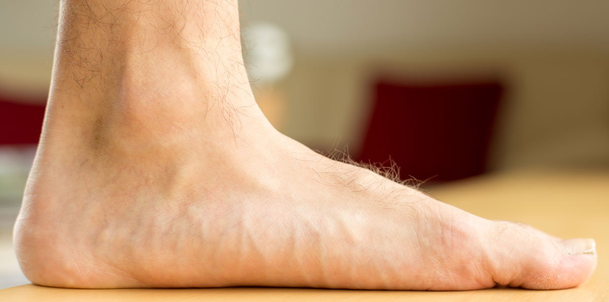 photo of a foot with a fallen arch